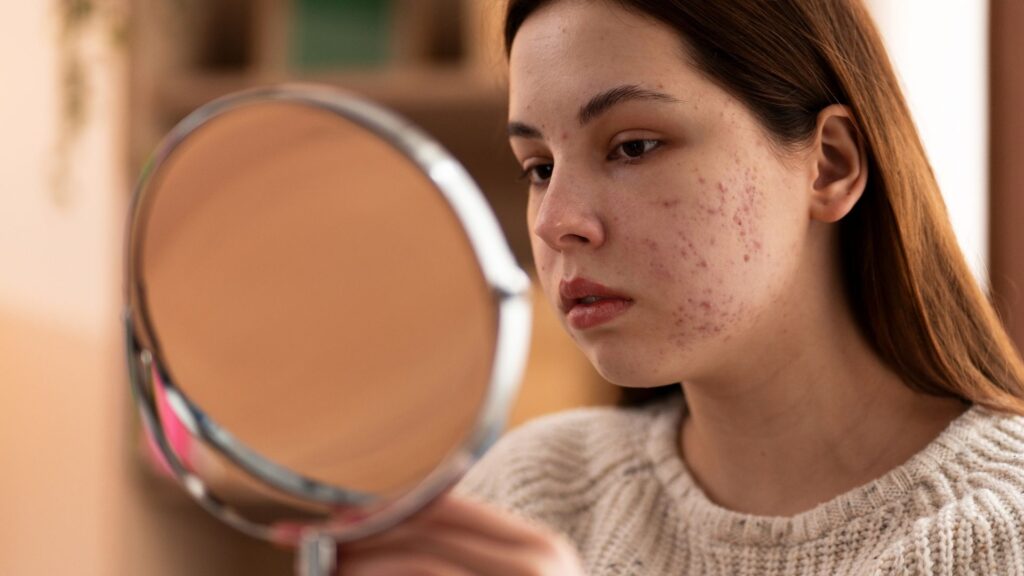 Acne adulta | Créditos: Divulgação