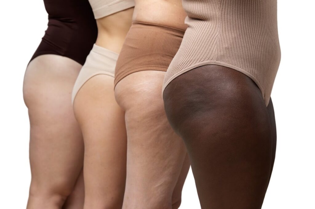 Sintomas da lipedema | Crédito: Freepik